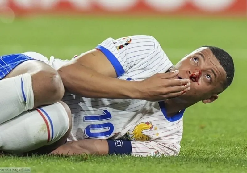 chấn thương mũi của mbappe