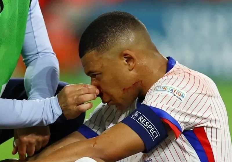 mbappe bị chấn thương mũi